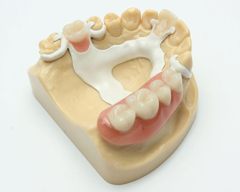 Ацеталовый съемный протез Ацеталовый съемный протез