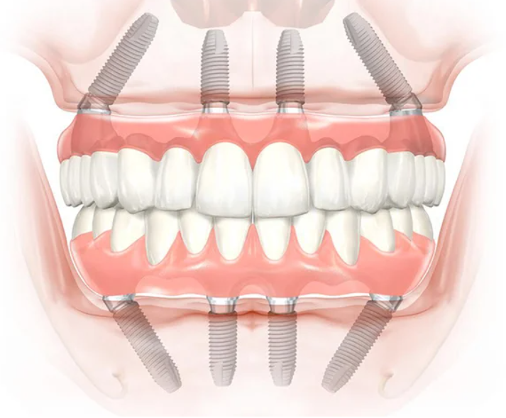 протезирование на 4-х имплантах all-on-4 протезирование на 4-х имплантах all-on-4