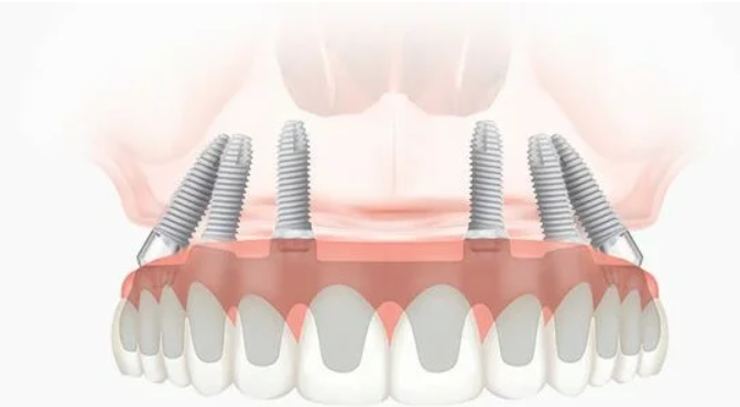 протезирование на 6-ти имплантах all-on-6 протезирование на 6-ти имплантах all-on-6
