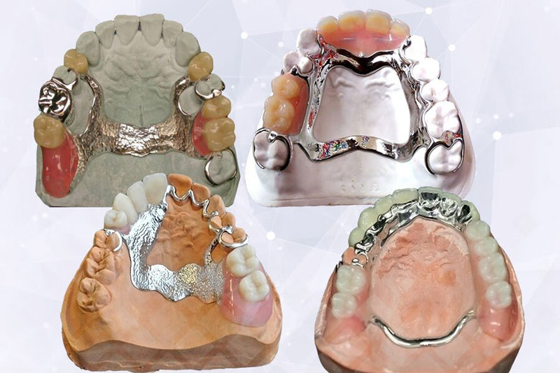 Бюгельный протез на верхнюю челюсть