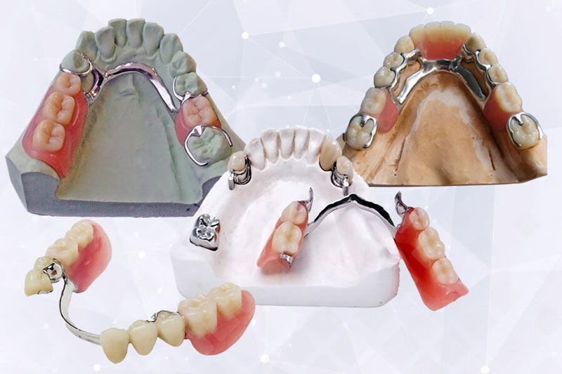 Бюгельный протез на нижнюю челюсть