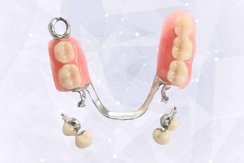 Бюгельный протез на замках