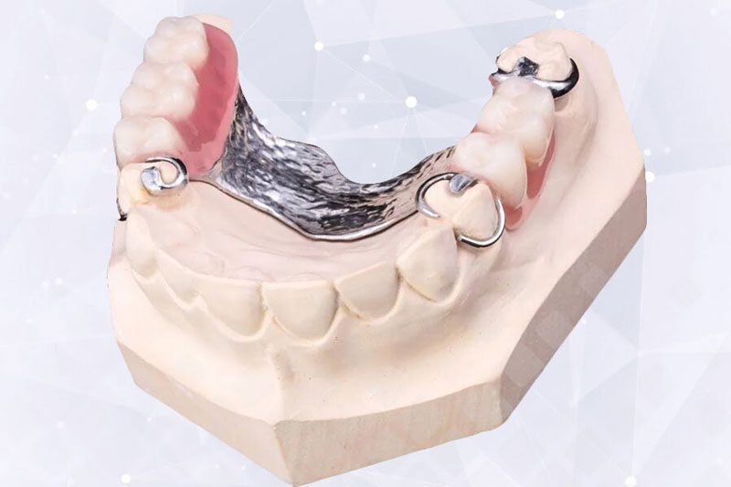 Бюгельный протез на кламмерах 