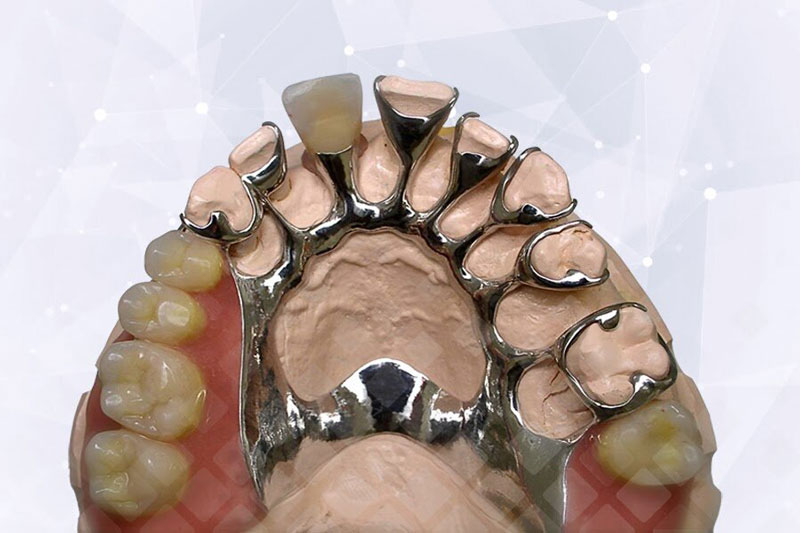 Шинирующий бюгельный протез