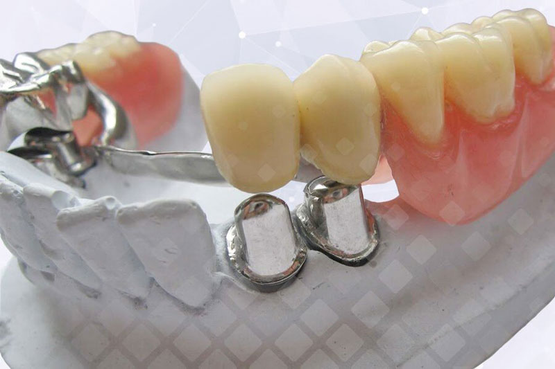 Бюгельный протез с креплением на телескопических коронках