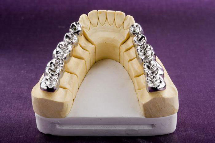 цельнолитой мостовидный протез цельнолитой мостовидный протез