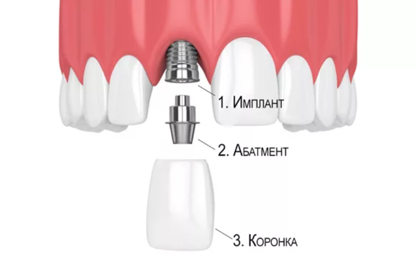 коронка на имплантате коронка на имплантате