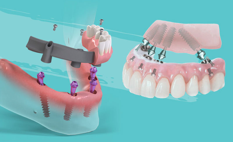 Одномоментная имплантация