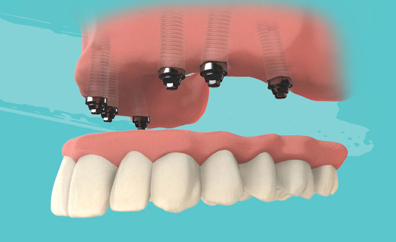 Имплантация с отсроченной нагрузкой