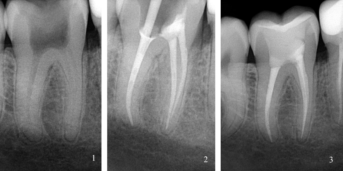 Лечение зуба под контролем визиографа
