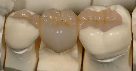 мостовидный протез на коронках и вкладках мостовидный протез на коронках и вкладках