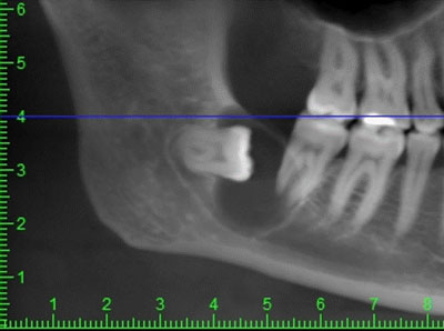 осложнения при прорезывании зубов мудрости осложнения при прорезывании зубов мудрости