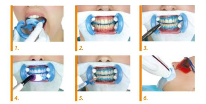 Этапы отбеливания зубов