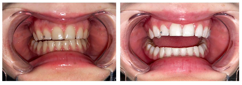Отбеливание зубов до и после Результат отбеливания за 1 процедуру