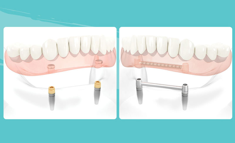 полный съемный протез на имплантах полный съемный протез на имплантах