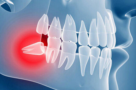 дистопированный зуб мудрости дистопированный зуб мудрости